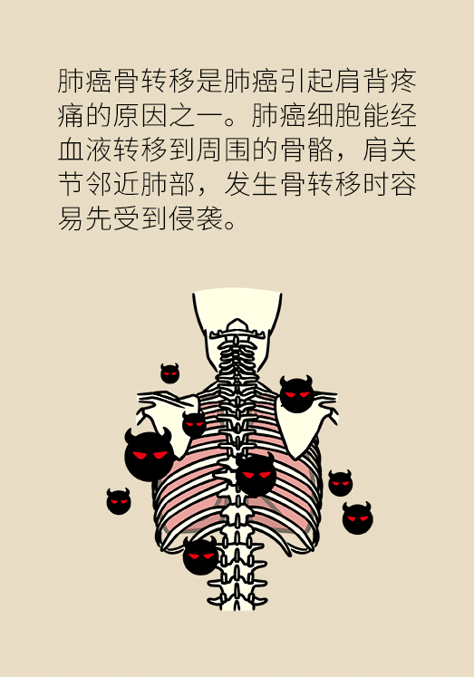 肩背疼痛久治不好别轻视,可能是肺癌